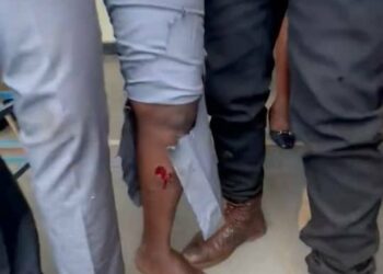 Bobi Wine’s injured leg